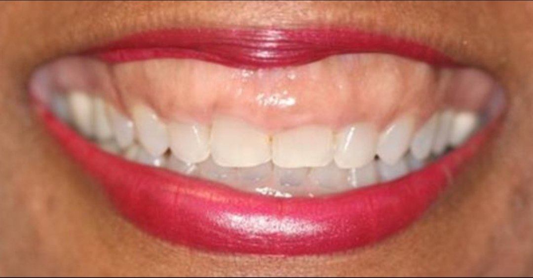 GUMMY SMILE CORECTION WITHOUT SURGERY IZC,AND TADS&CROWN LENGTHENING