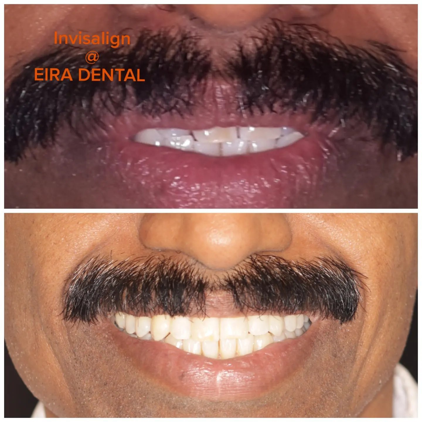 INVISALIGN AND IMPLANT WITH ITERO SCANNER-AT EIRA DENTAL